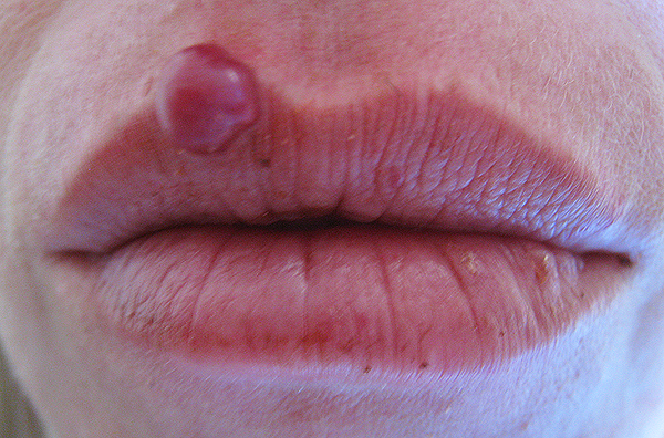 blisters inside mouth